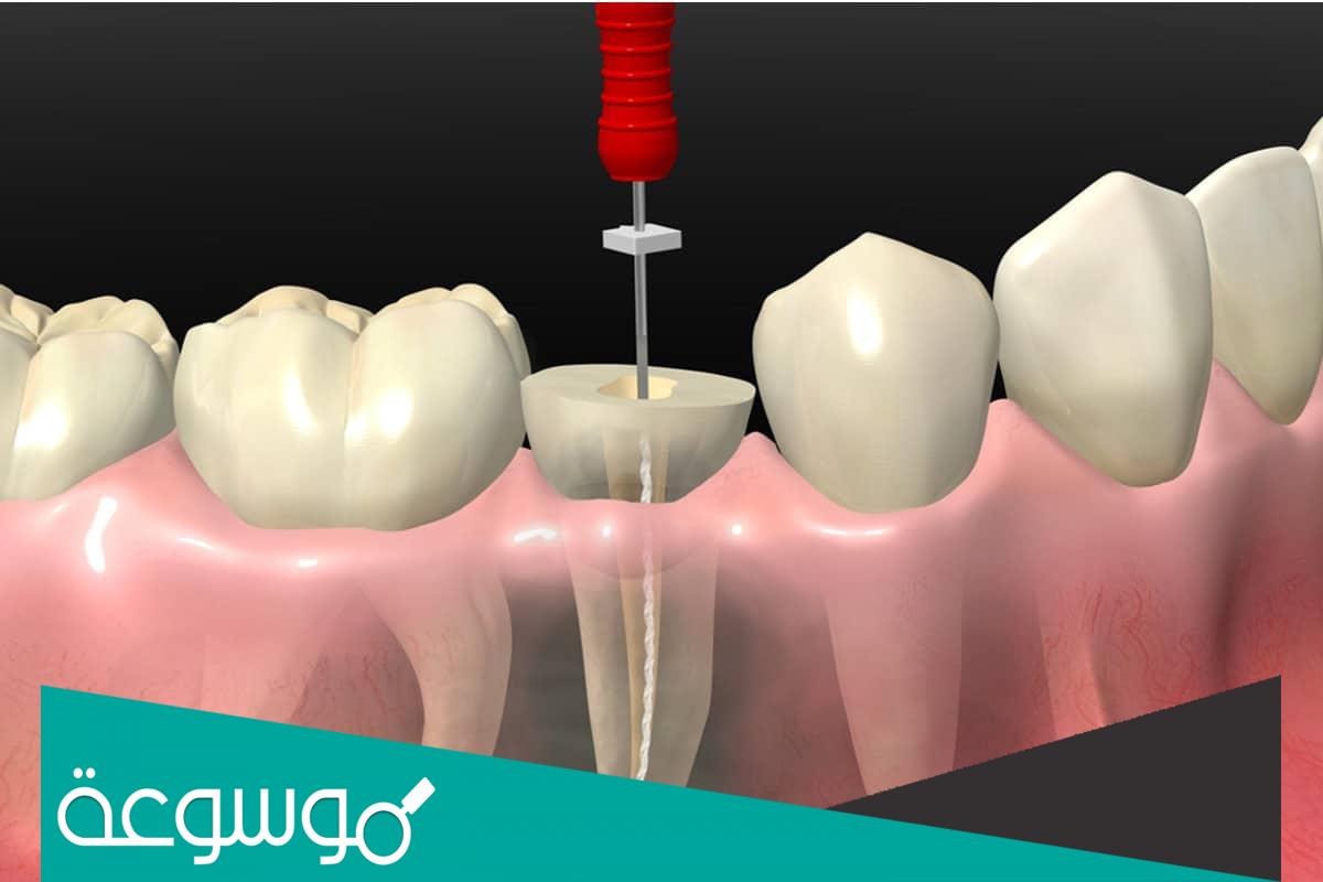 كيف يتم حشو العصب وما هي أنواع الحشوة