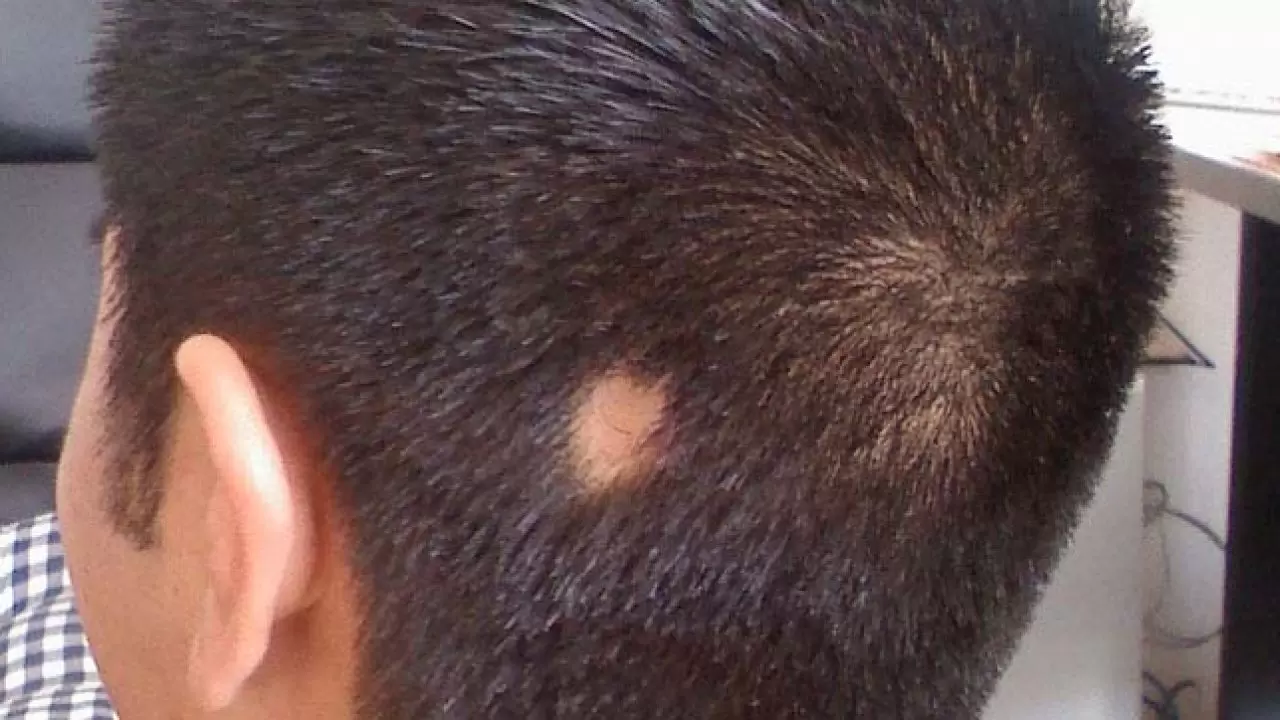 علاج الثعلبة مجرب وأسباب الإصابة بالثعلبة