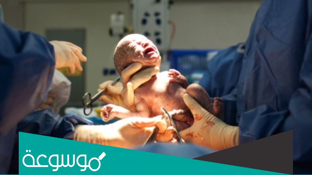 لماذا سميت العملية القيصرية بهذا الاسم