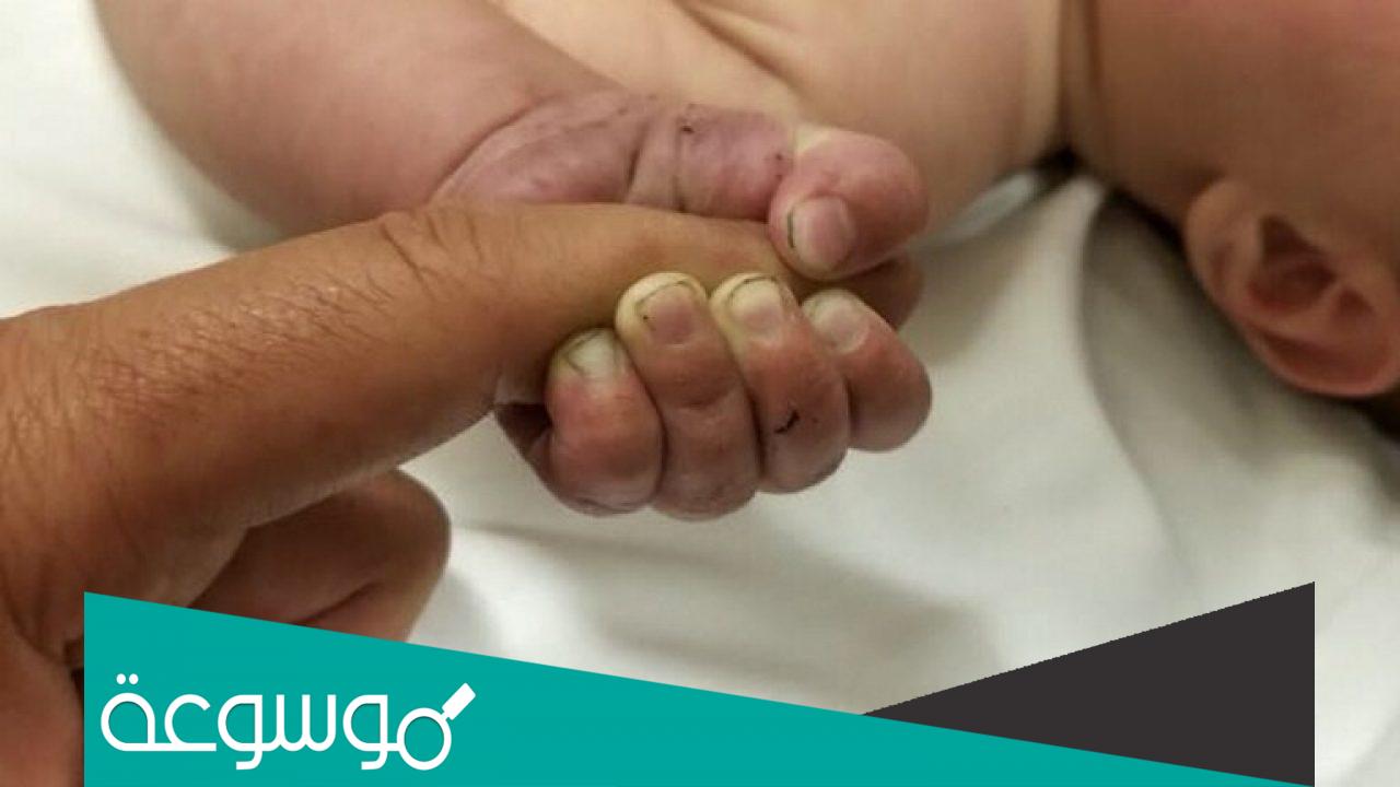 ما هو مرض الطفل الشمعي وهل يشفى ام لا