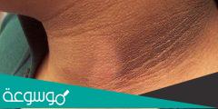 كيفية علاج سواد الرقبة وما هي أسبابه