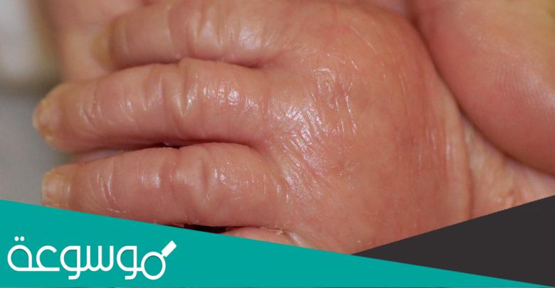 معلومات عن الطفل الشمعي ويكيبيديا