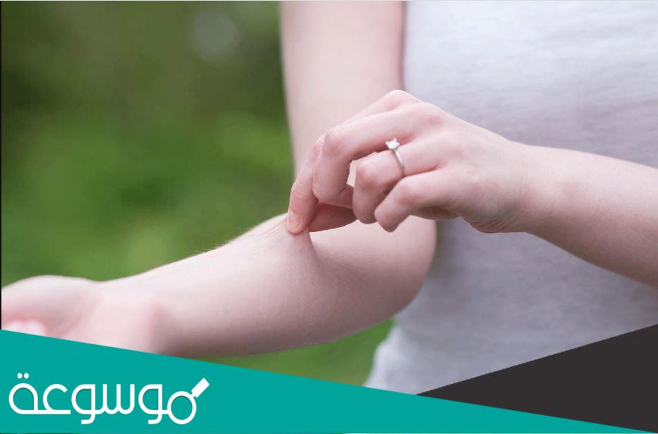 معلومات عن متلازمة اهلرز دانلوس ويكيبيديا