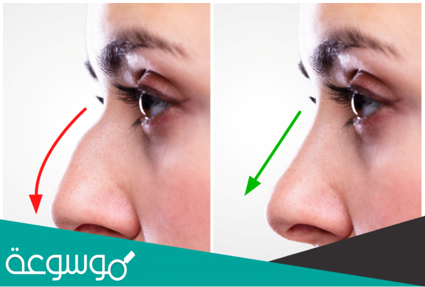 كم تكلفة عملية تجميل الأنف بالخيوط في دبي