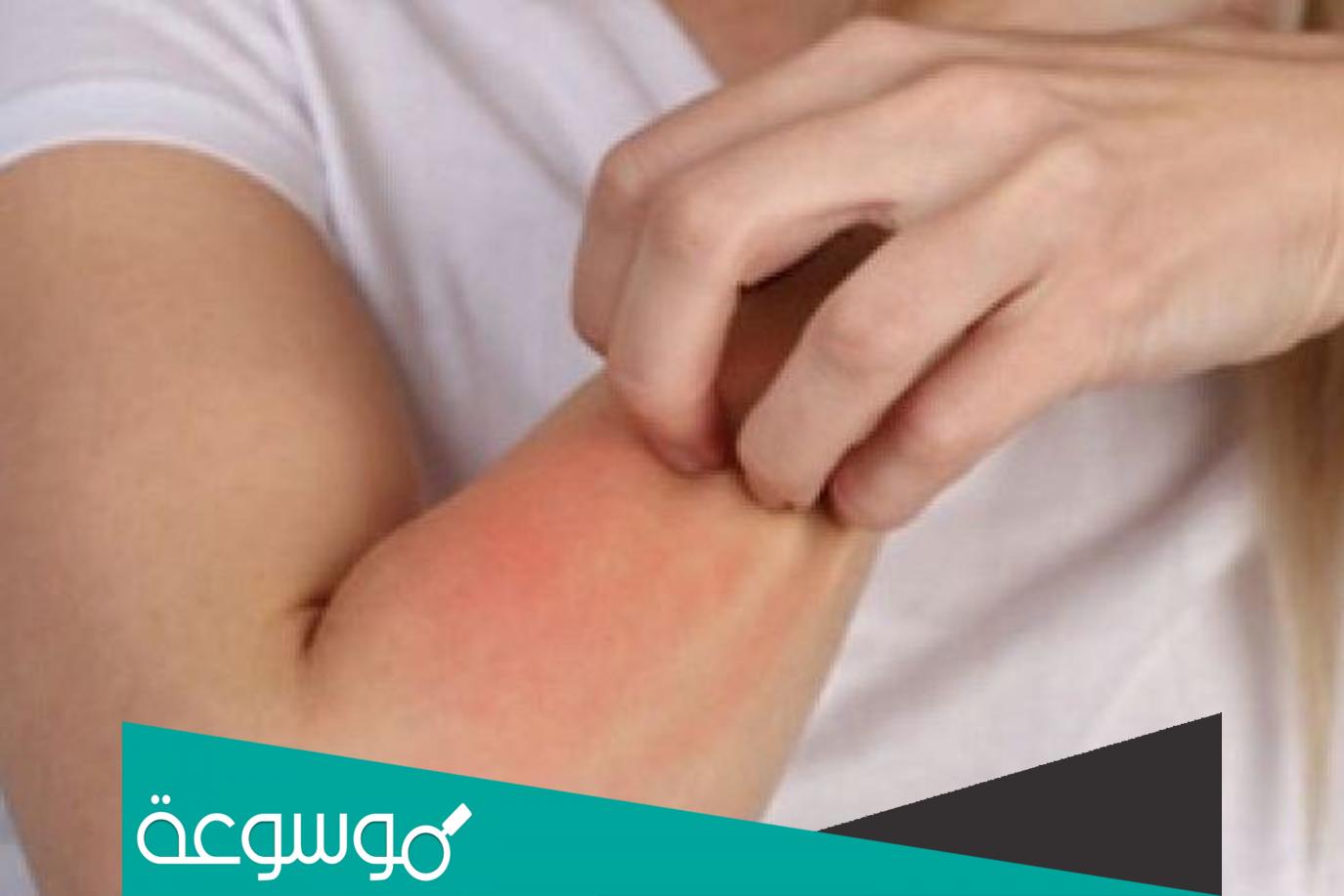 اسباب حساسية الجلد المفاجئة