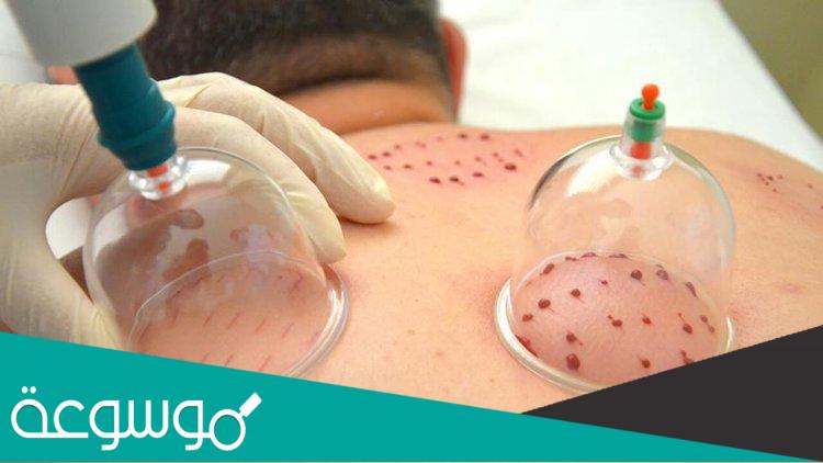 افضل ايام الحجامة لهذا الشهر