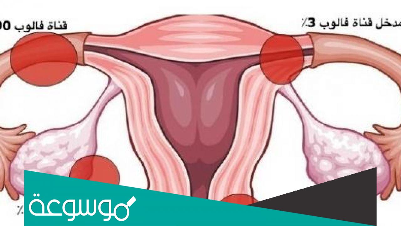 تجربتي مع انسداد قناة فالوب