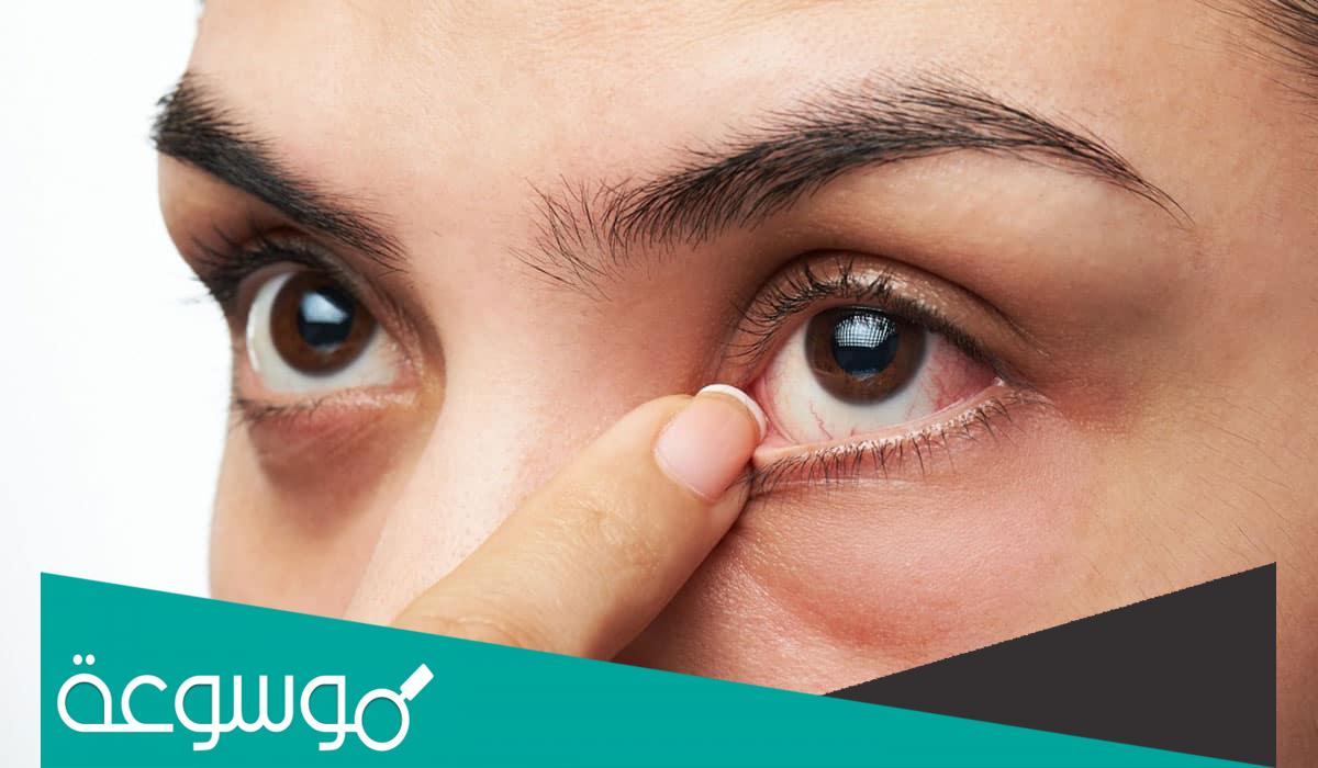 علاج انتفاخ تحت العين طبيعيًا وطبيًا