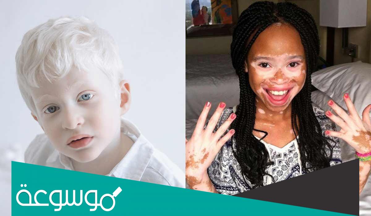 ما الفرق بين البهاق والبرص