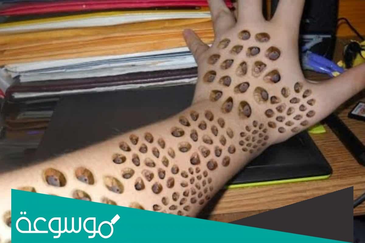 ما هو رهاب النخاريب