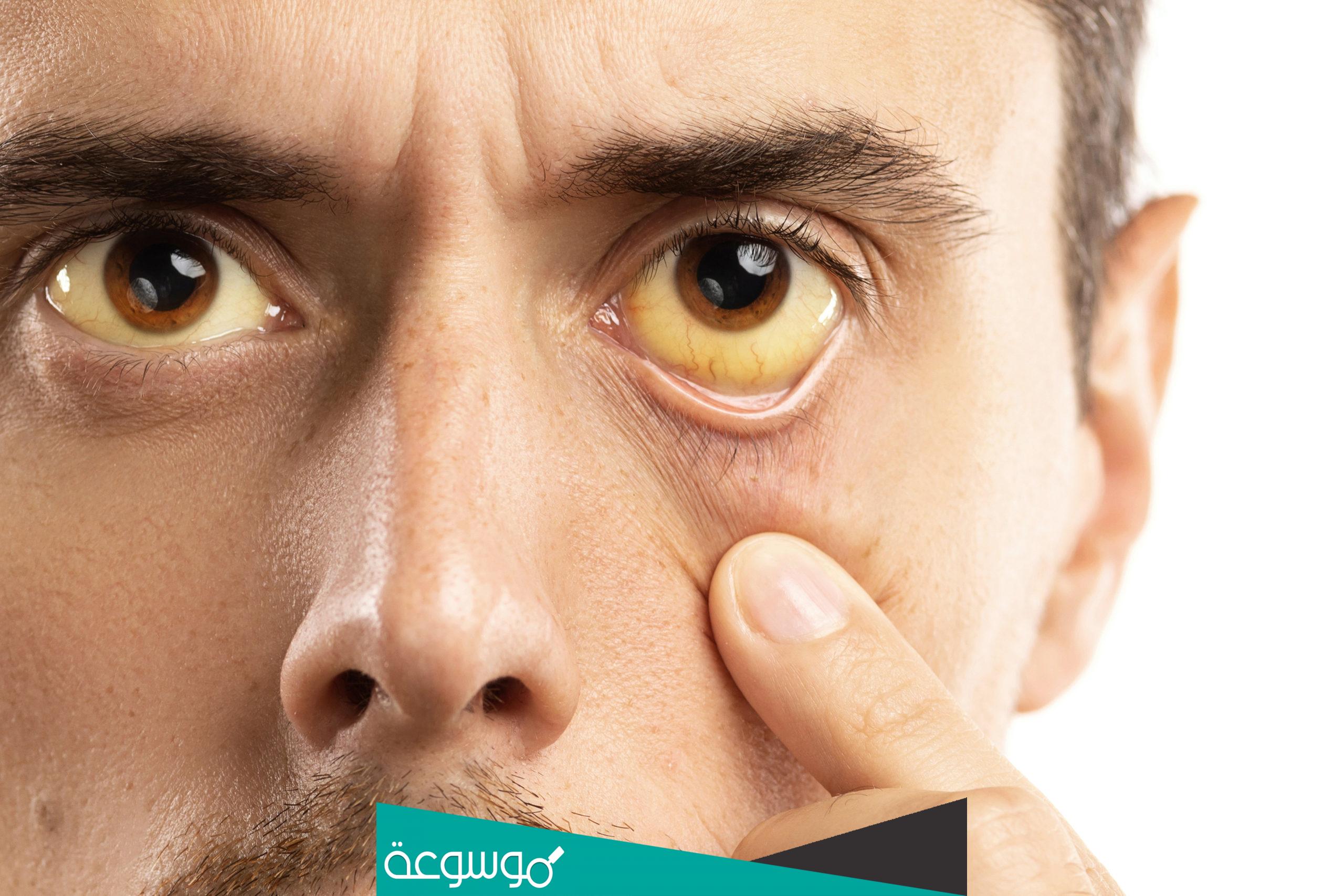 هل مرض الصفراء معدي