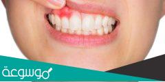 علاج التهاب اللثه بالمره