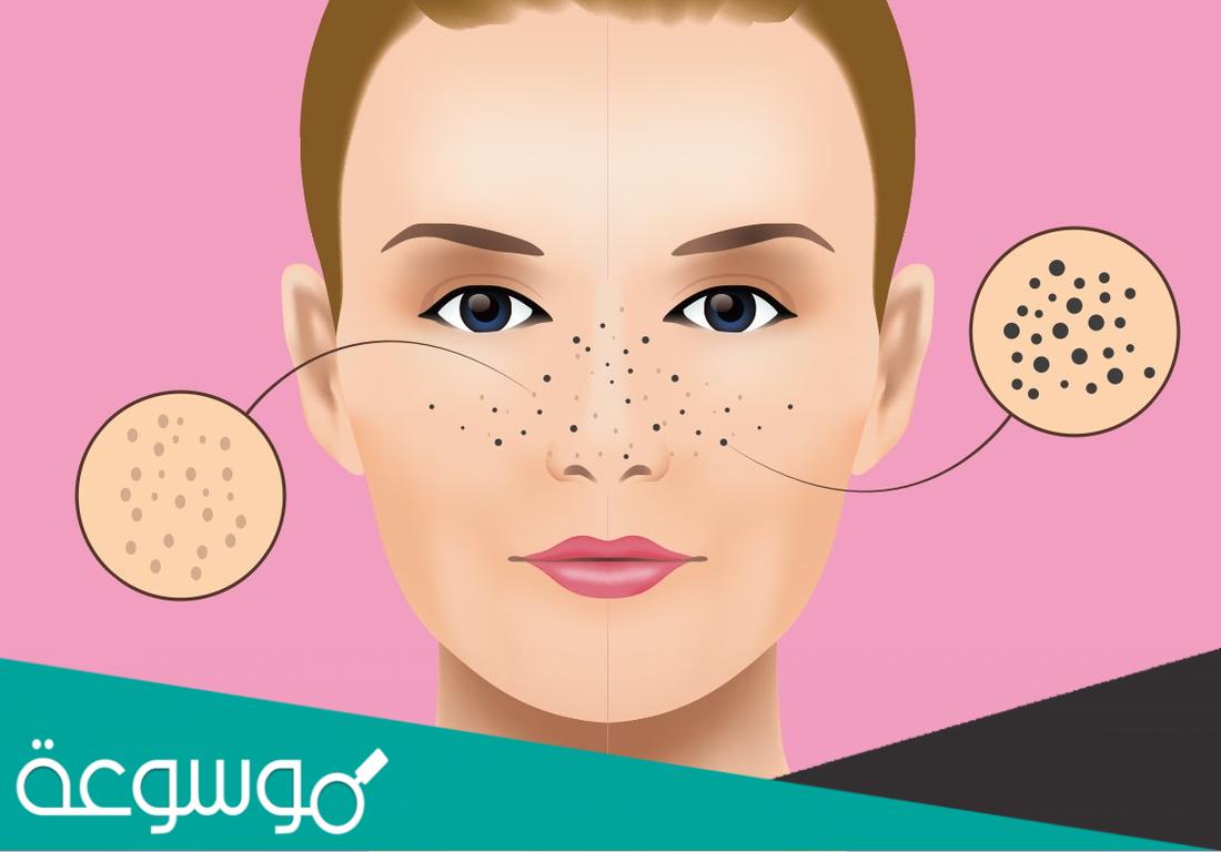 إزالة الرؤوس السوداء من الأنف من اول مرة