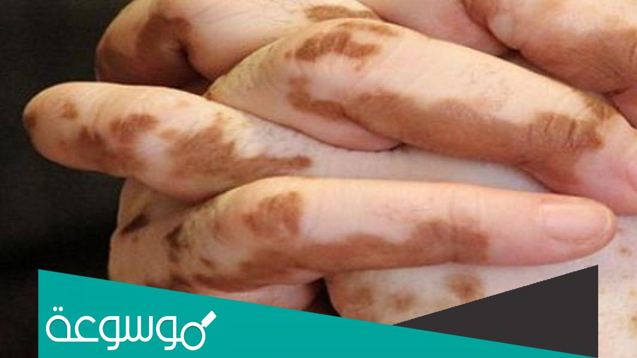 الفرق بين البهاق والبرص