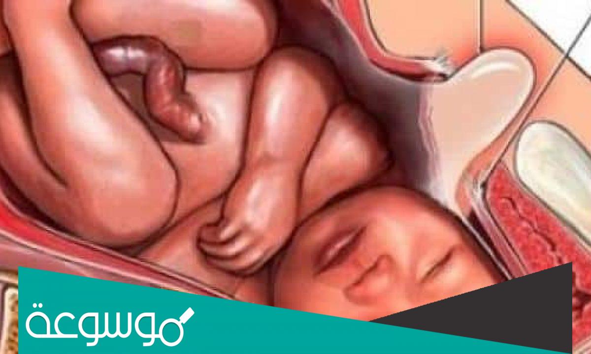 تجربتي في نزول رأس الجنين