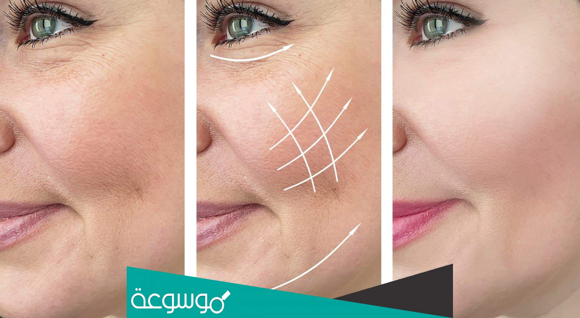 تجربتي مع ابرة البروفايلو | تجارب والمميزات والسلبيات