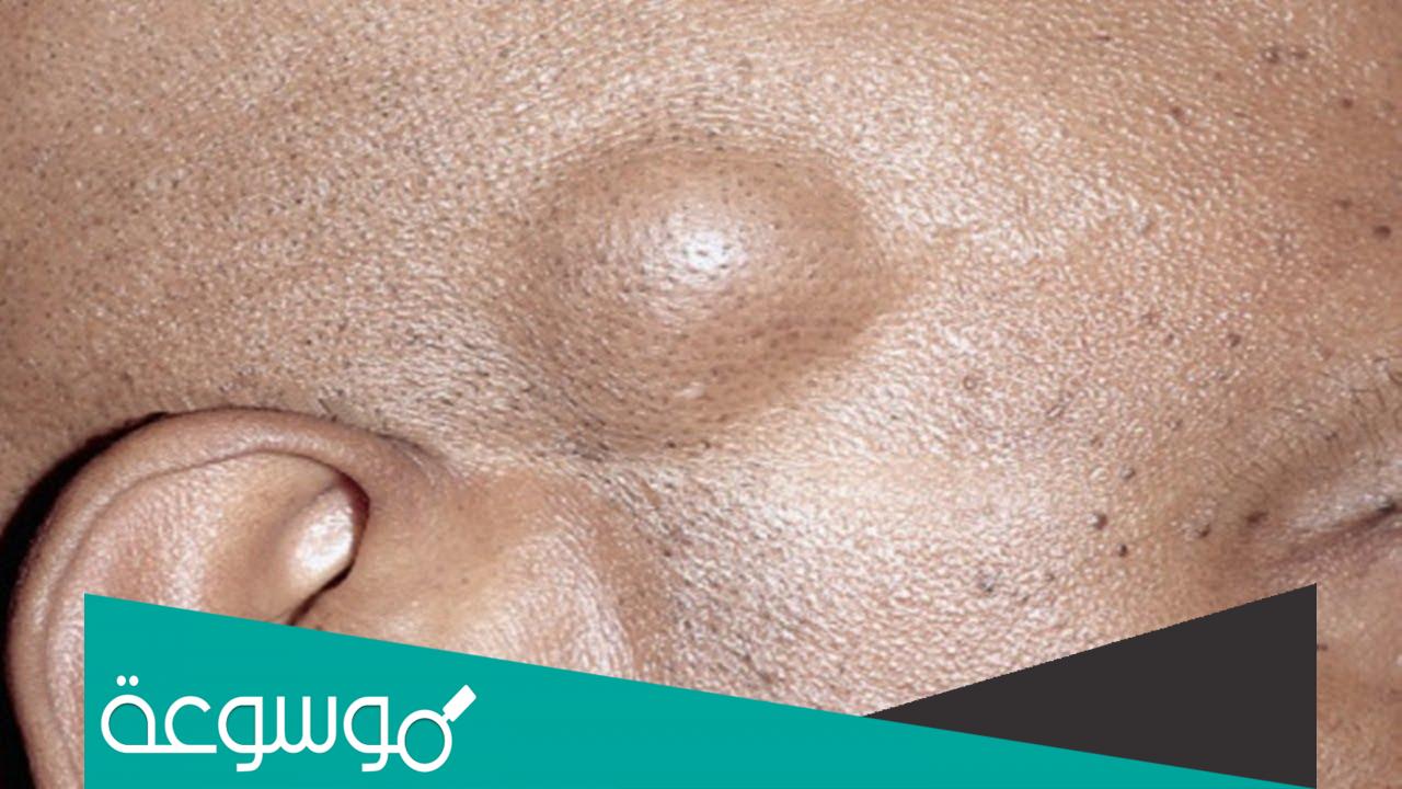 تجربتي مع الكيس الدهني في الرأس