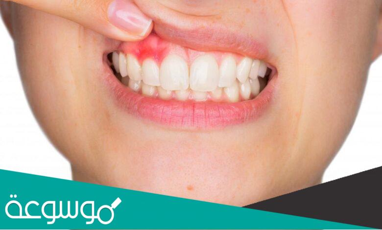 تجربتي مع انحسار اللثة | الجير والتدخين والتنظيف