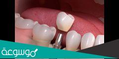 تجربتي مع زراعة الأسنان | التقنيات والنتائج والميزات