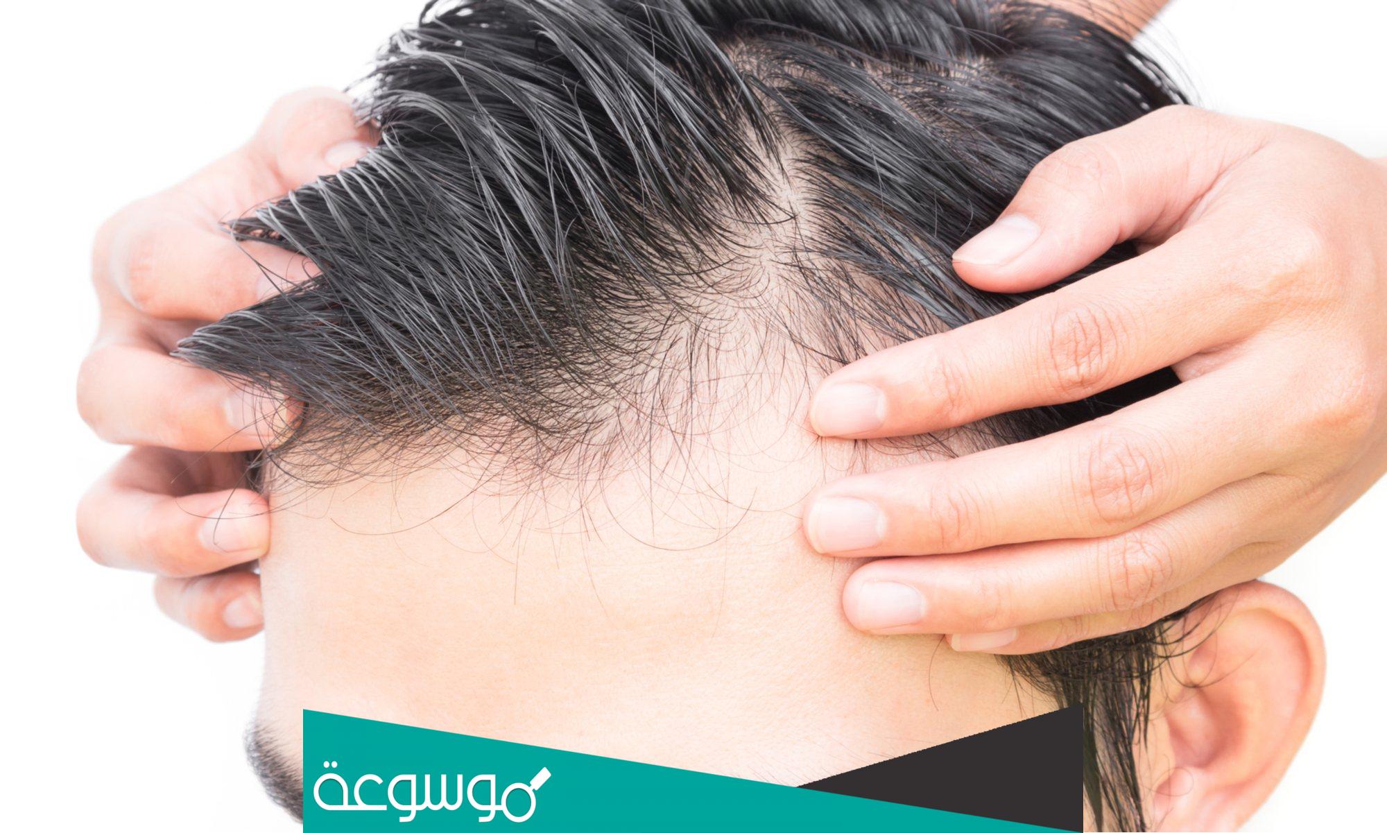 تجربتي مع فيناسترايد