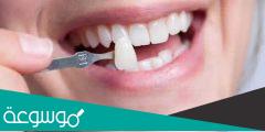 تركيب الاسنان | الانواع والاسعار والميزات والعيوب