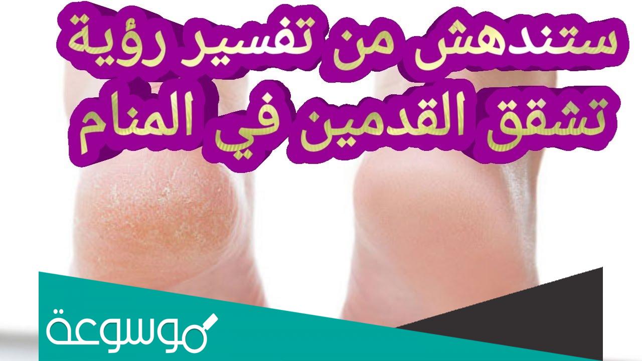 تفسير حلم رؤية تشقق القدمين في المنام