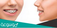 تقويم الاسنان | انواع واسعار وعيوب وخطوات التركيب