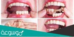 تلبيس الأسنان | سحب العصب انواع وطرق تركيب التاج