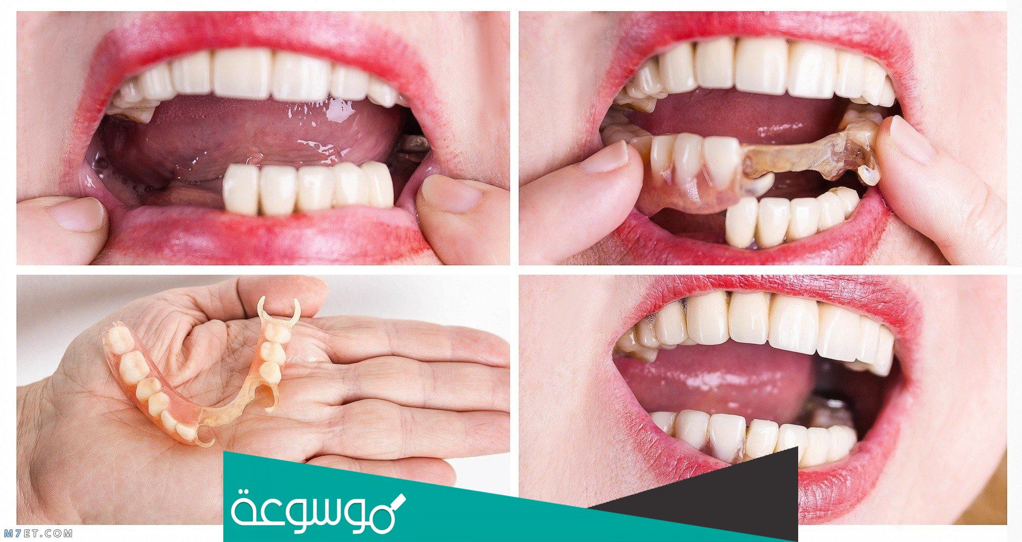 تلبيس الأسنان | سحب العصب انواع وطرق تركيب التاج