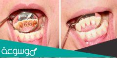 تنظيف الاسنان من الجير | الخطوات والنتائج والتكلفة