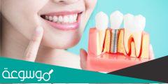 جسور الأسنان | الأنواع و الاسعار والفوائد وأكثر