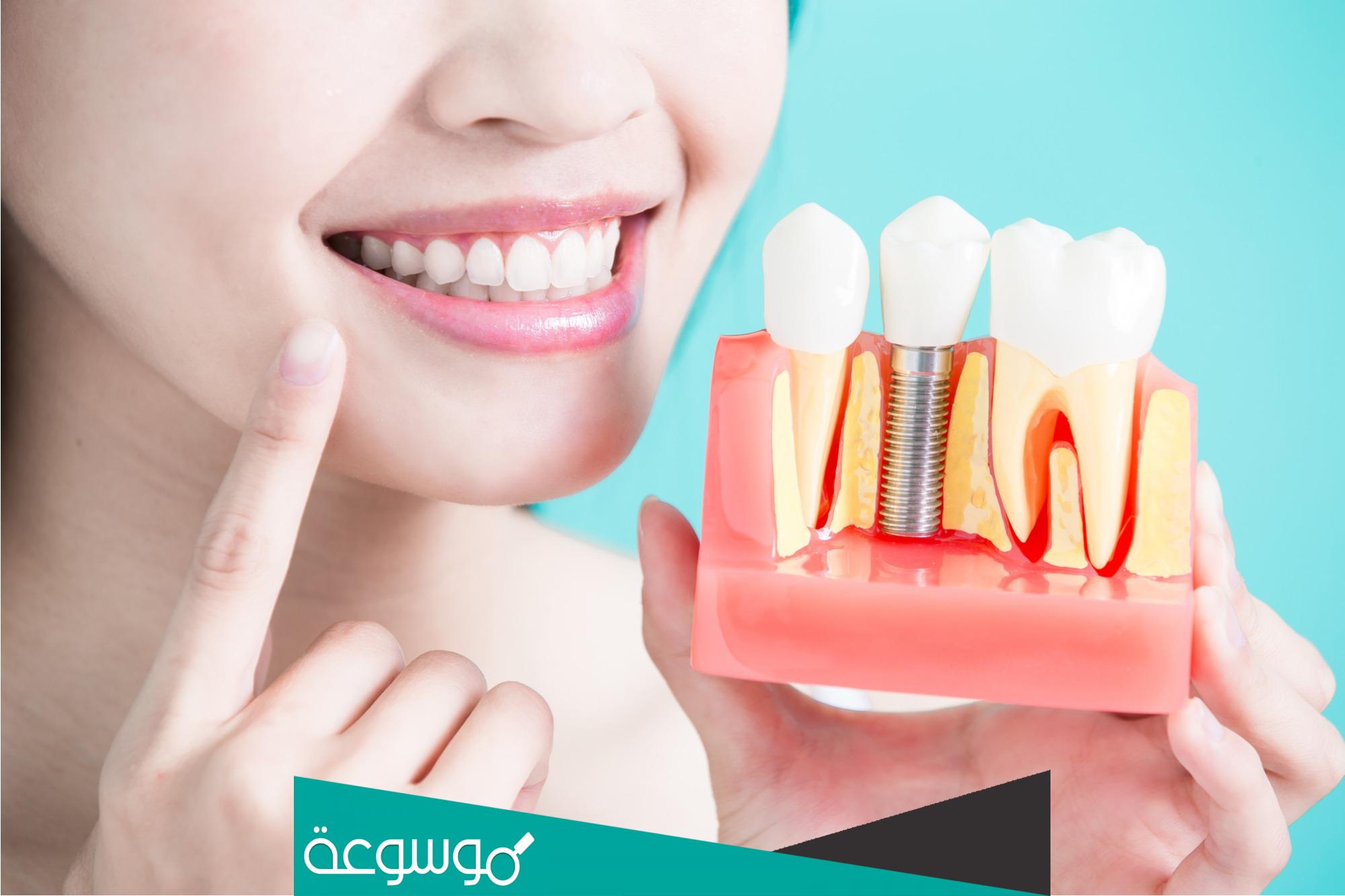 جسور الأسنان | الأنواع و الاسعار والفوائد وأكثر
