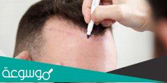 زراعة الشعر في الرياض | التكلفة والأطباء والعيادات