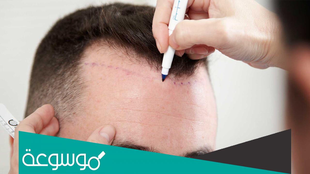 زراعة الشعر في الرياض التكلفة والأطباء والعيادات