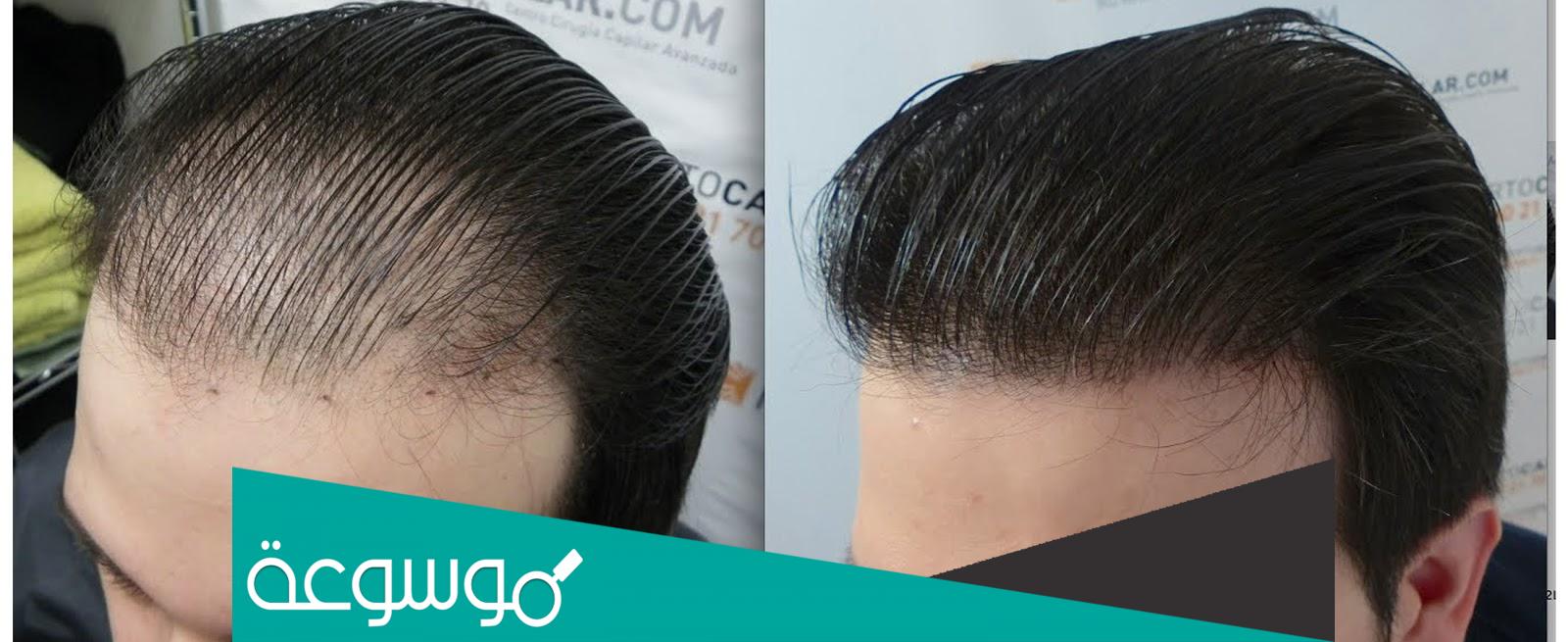 زراعة الشعر في السعودية الأسعار والأطباء والعيادات وأكثر