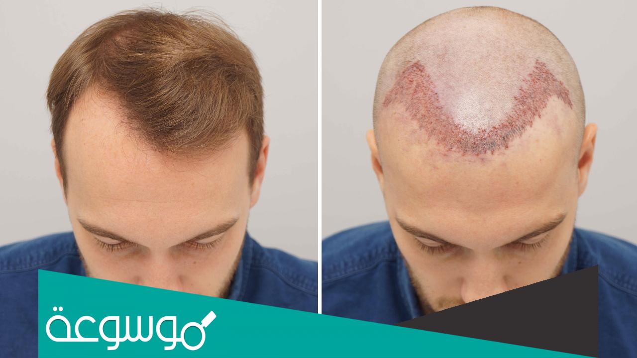 كم تكلفة زراعة الشعر في تركيا بالريال السعودي