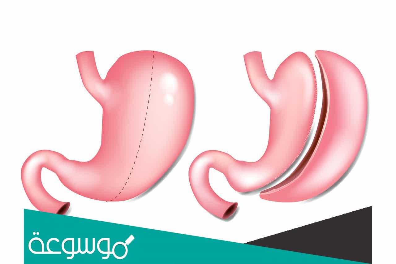 كم تكلفة عملية تكميم المعدة في مصر