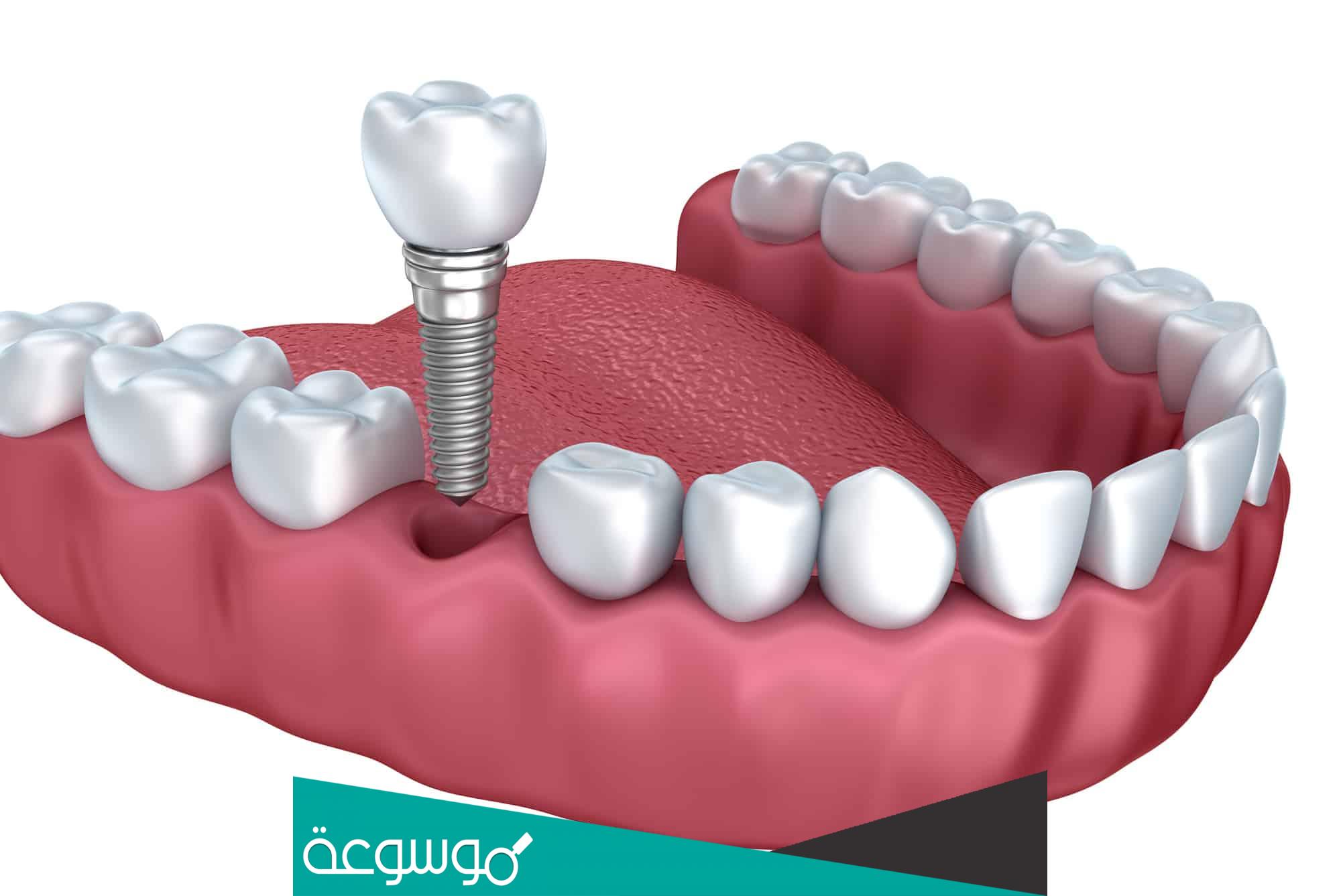 كم سعر زراعة الاسنان في المهيدب؟ | السعودية والتيجان