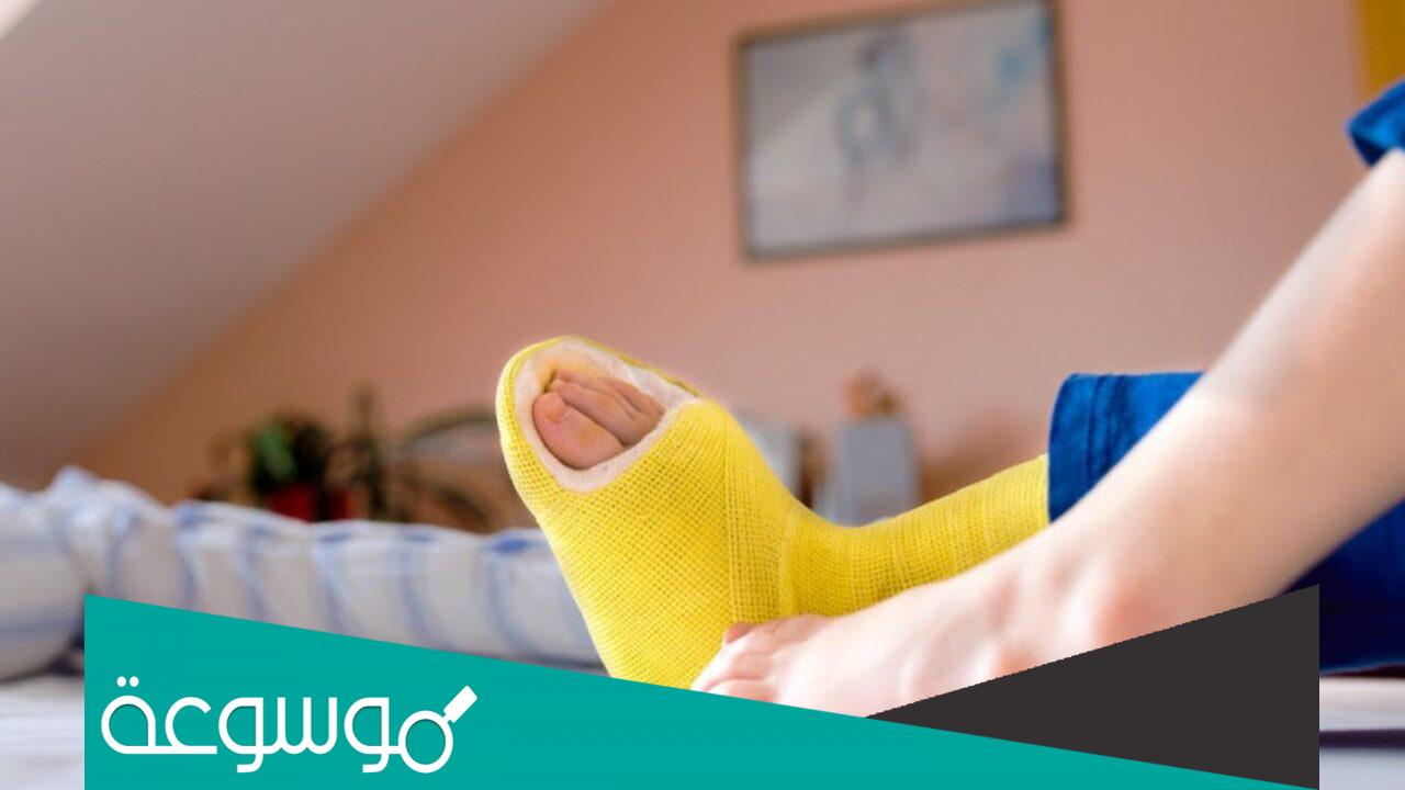 كم مدة الجبس في القدم وقت الكسر