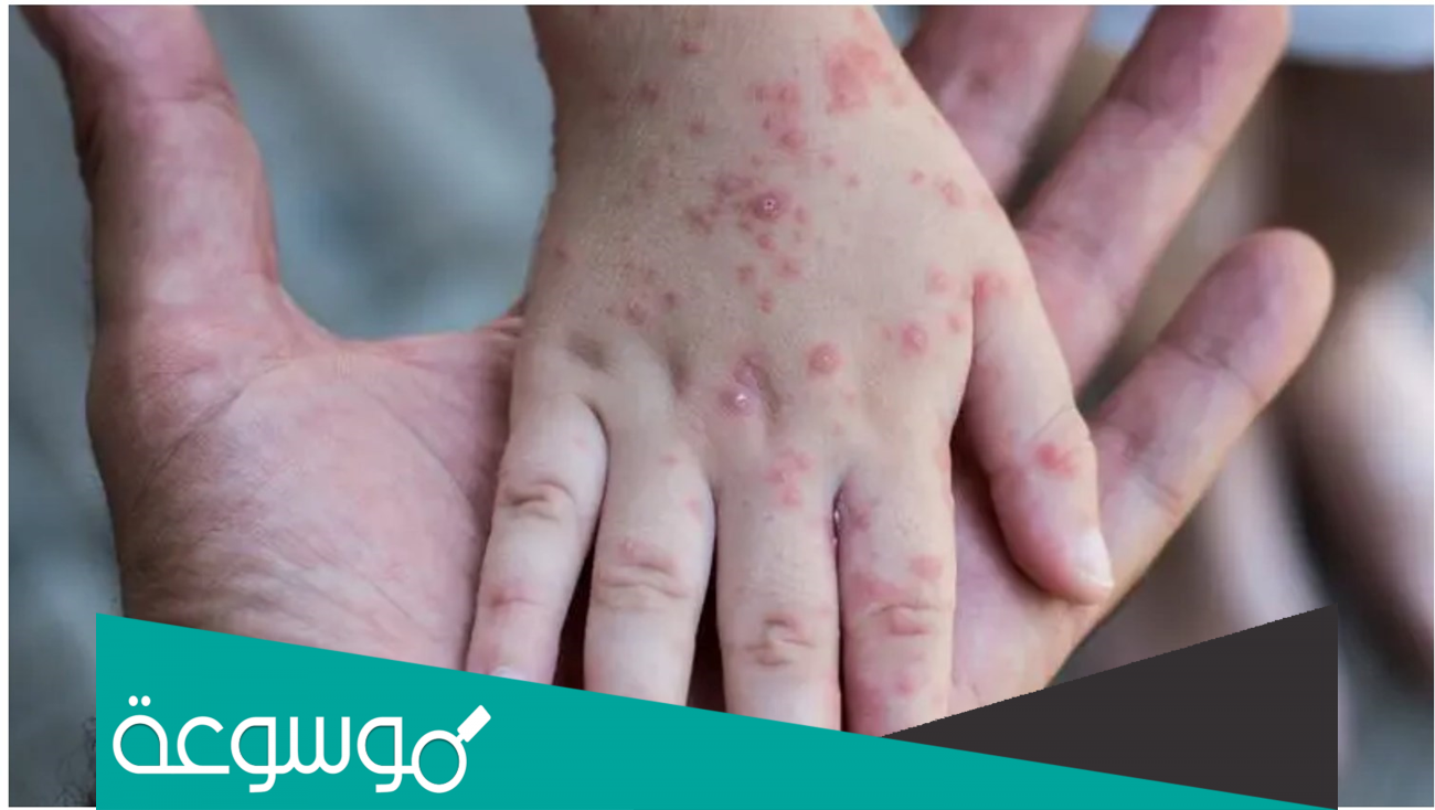 كم مدة حجر مصاب جدري القرود