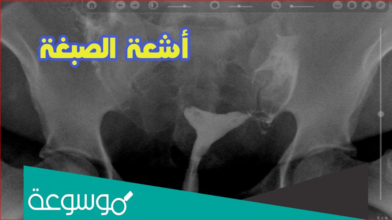 كم يستمر الألم بعد أشعة الصبغة