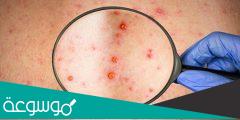 كيف ينتشر جدري القرود
