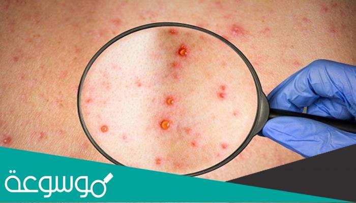 كيف ينتشر جدري القرود