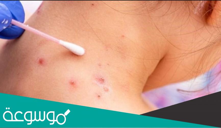 كيف ينتقل جدري القرود بين البشر؟