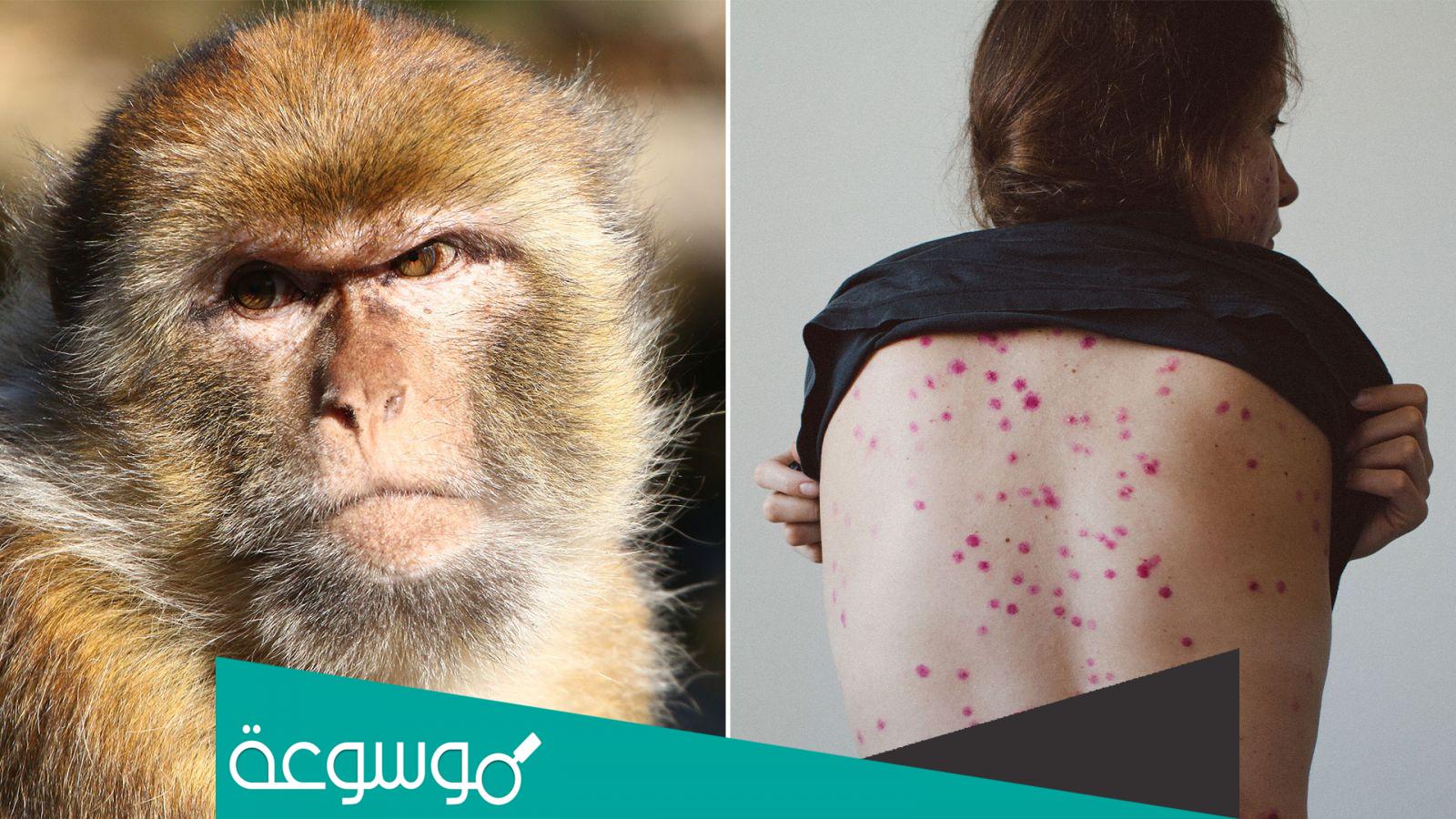 ما الفرق بين جدري القرود وفيروس كورونا