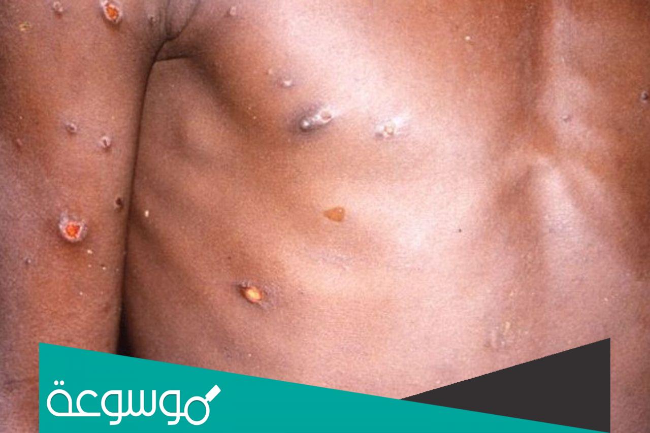 ما هو جدري القرود