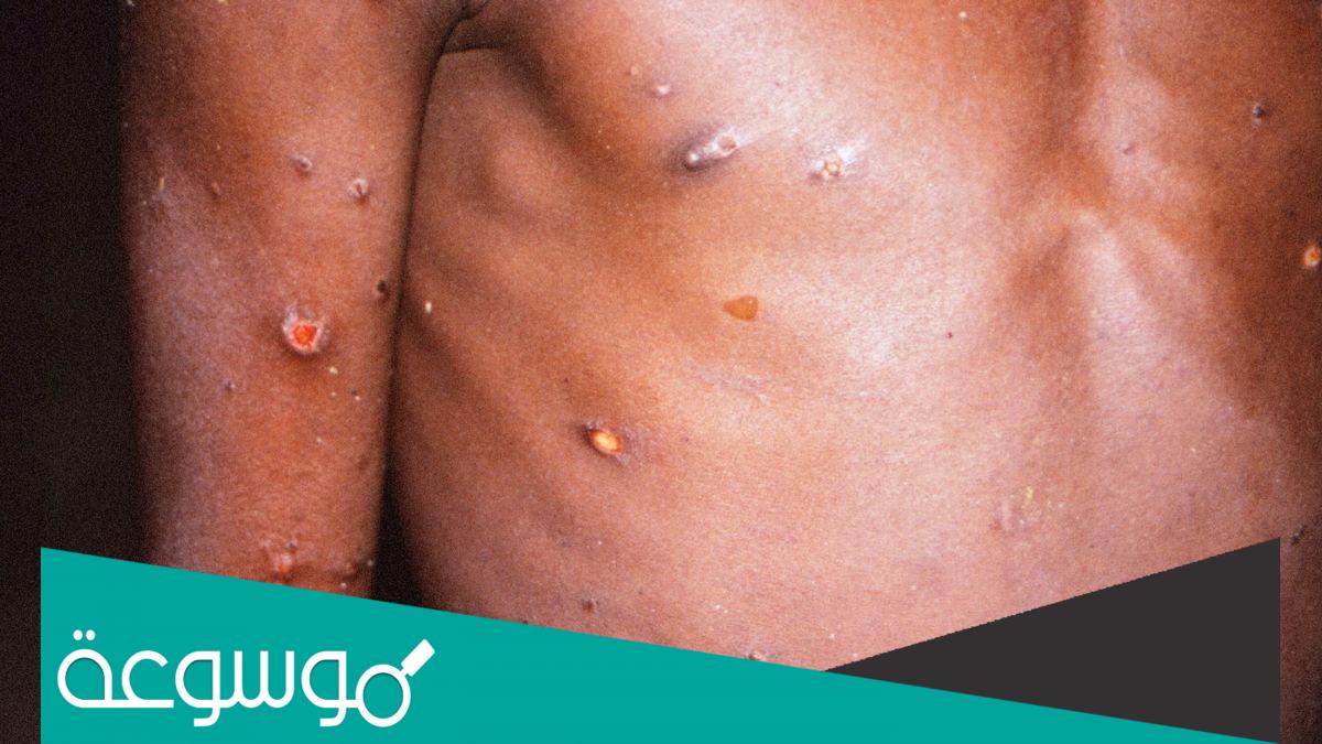 ما هي طرق انتقال جدري القرود