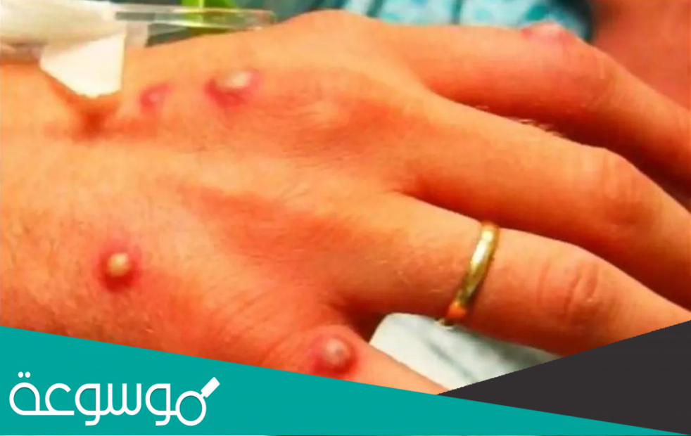 معلومات عن جدري القرود