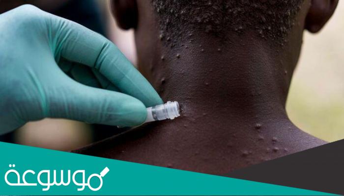 من اين اتى جدري القرود