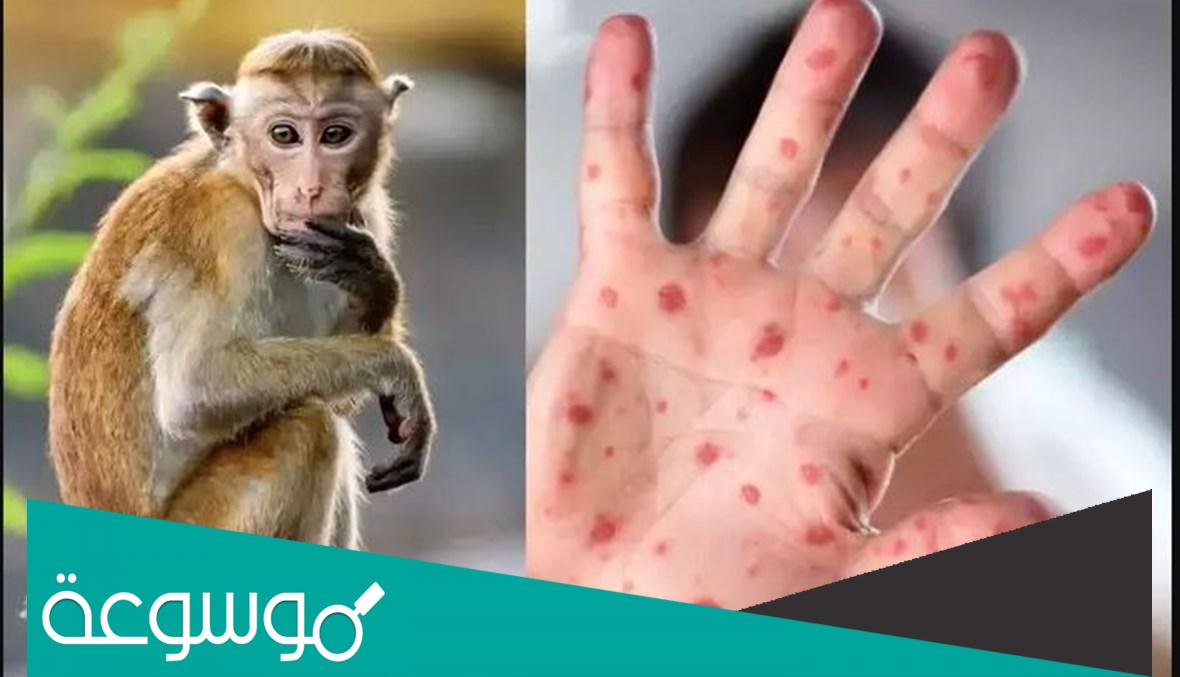 هل جدري القرود قاتل